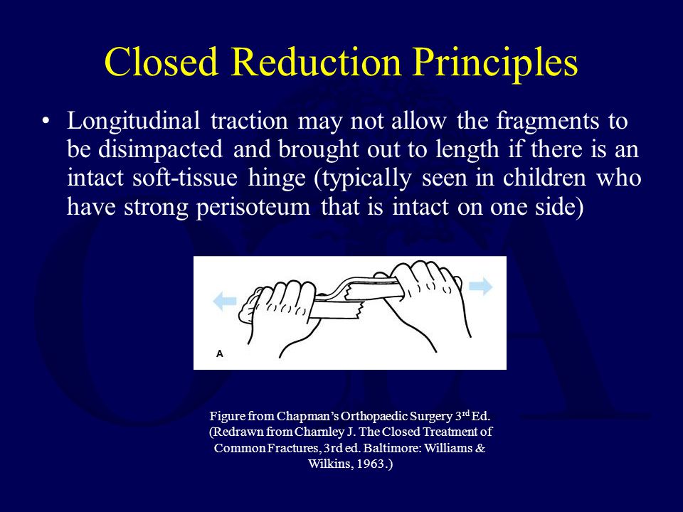 Closed Reduction Traction and Casting Techniques ppt video